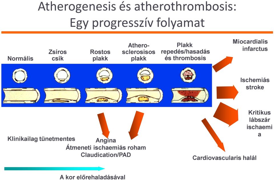 Miocardialis infarctus Ischemiás stroke Klinikailag tünetmentes Angina Átmeneti