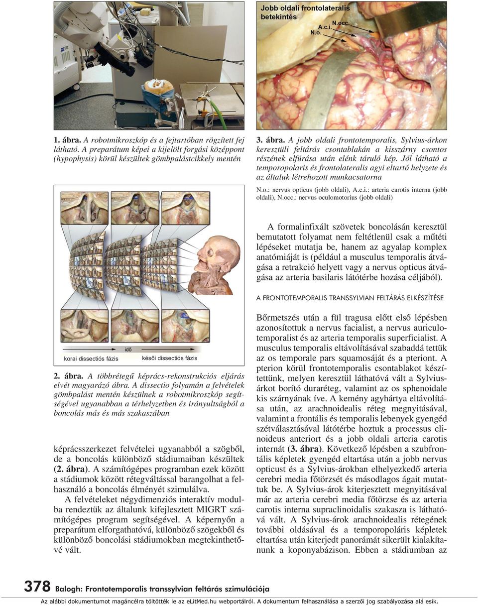 A jobb oldali frontotemporalis, Sylvius-árkon keresztüli feltárás csontablakán a kisszárny csontos részének elfúrása után elénk táruló kép.