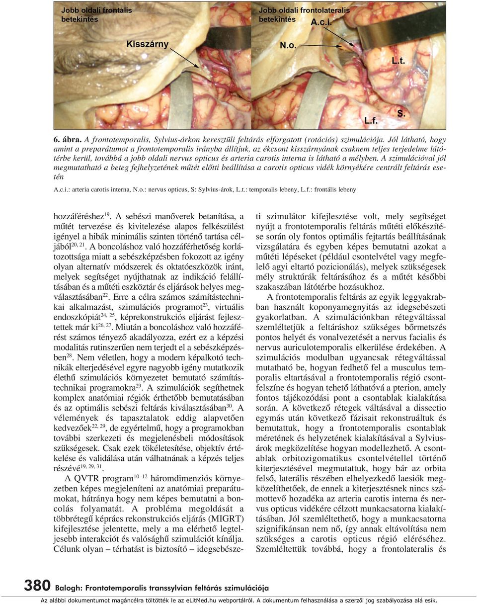 interna is látható a mélyben. A szimulációval jól megmutatható a beteg fejhelyzetének mûtét elôtti beállítása a carotis opticus vidék környékére centrált feltárás esetén A.c.i.: arteria carotis interna, N.