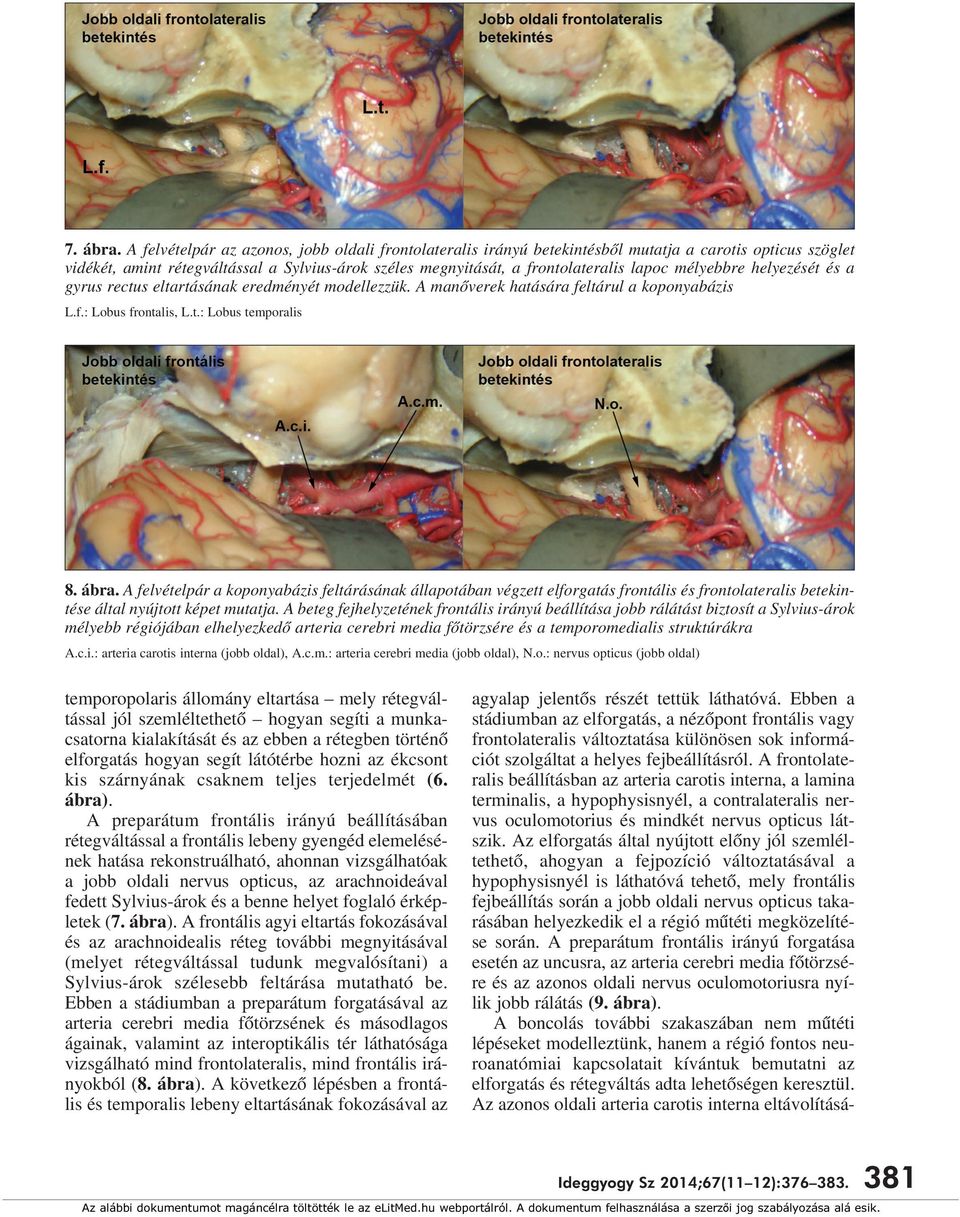 mélyebbre helyezését és a gyrus rectus eltartásának eredményét modellezzük. A manôverek hatására feltárul a koponyabázis L.f.: Lobus frontalis, L.t.: Lobus temporalis 8. ábra.