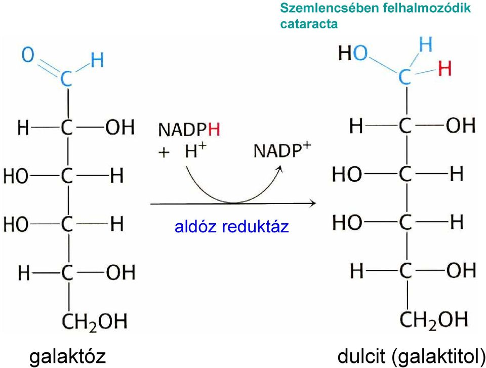 cataracta aldóz