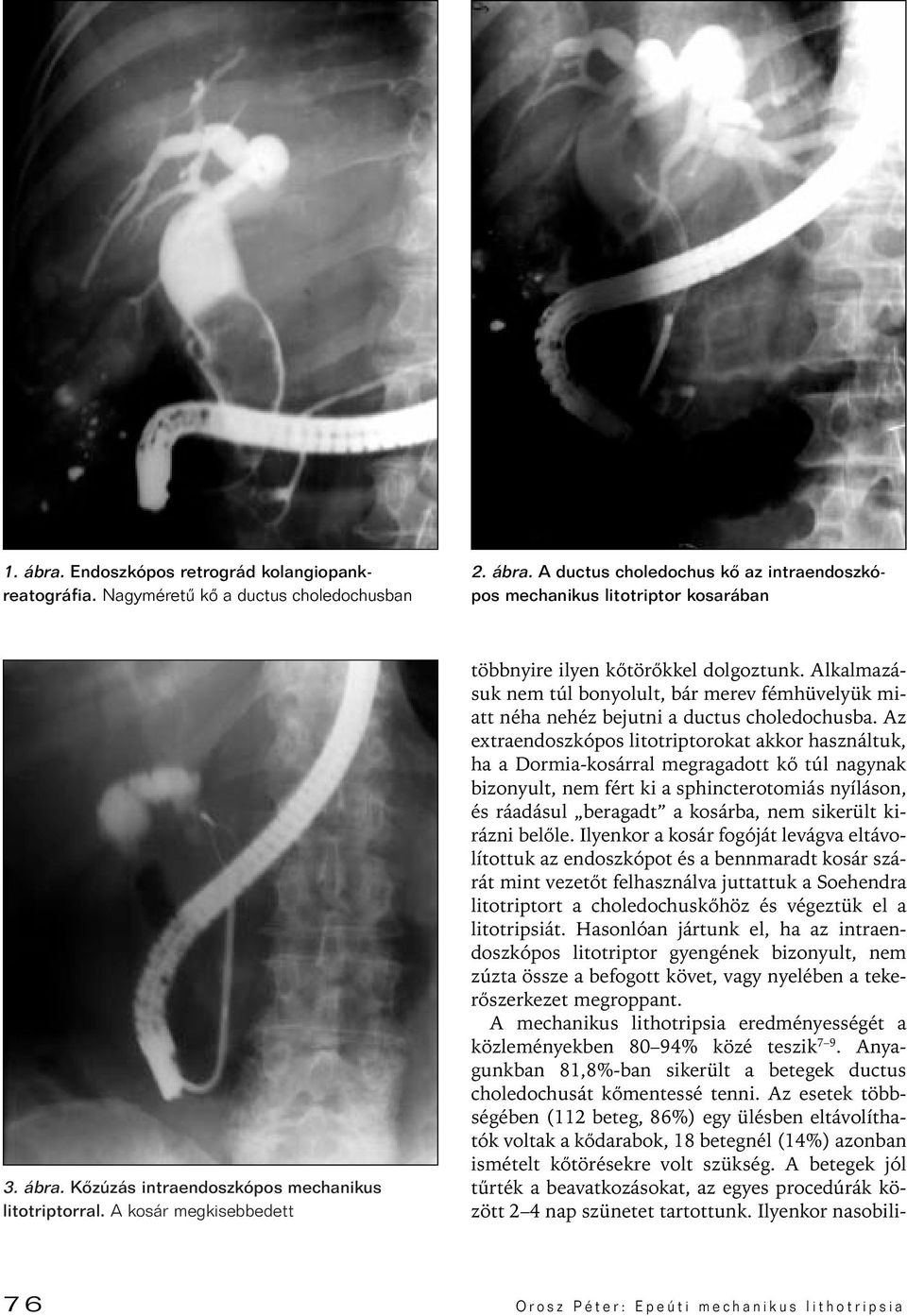 Az extraendoszkópos litotriptorokat akkor használtuk, ha a Dormia-kosárral megragadott kô túl nagynak bizonyult, nem fért ki a sphincterotomiás nyíláson, és ráadásul beragadt a kosárba, nem sikerült