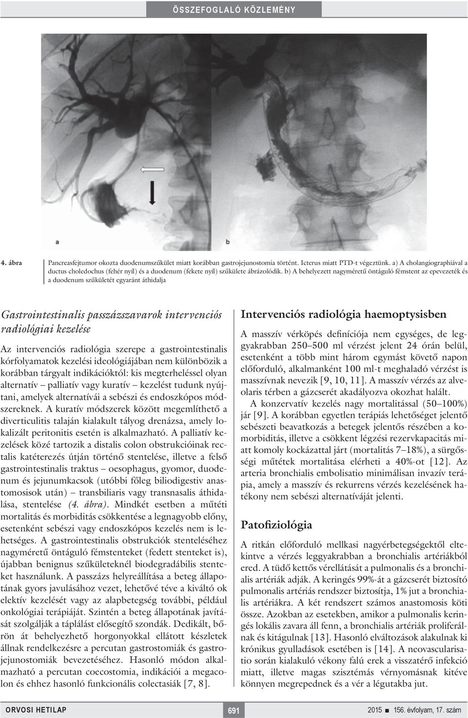 b) A behelyezett nagyméretű öntáguló fémstent az epevezeték és a duodenum szűkületét egyaránt áthidalja Gastrointestinalis passzázszavarok intervenciós radiológiai kezelése Az intervenciós radiológia