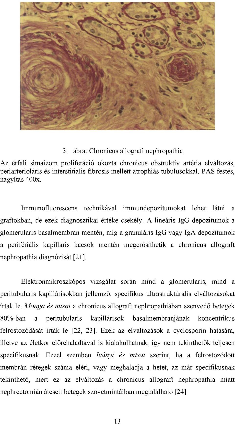 A lineáris IgG depozitumok a glomerularis basalmembran mentén, míg a granuláris IgG vagy IgA depozitumok a perifériális kapilláris kacsok mentén megerősíthetik a chronicus allograft nephropathia