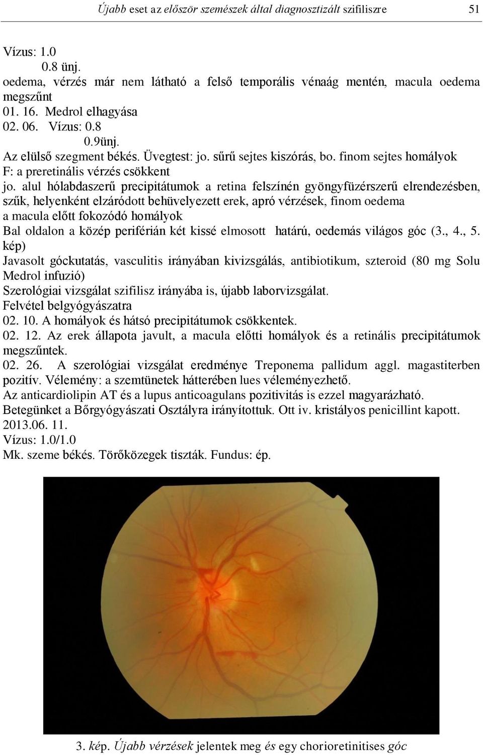 alul hólabdaszerű precipitátumok a retina felszínén gyöngyfüzérszerű elrendezésben, szűk, helyenként elzáródott behüvelyezett erek, apró vérzések, finom oedema a macula előtt fokozódó homályok Bal