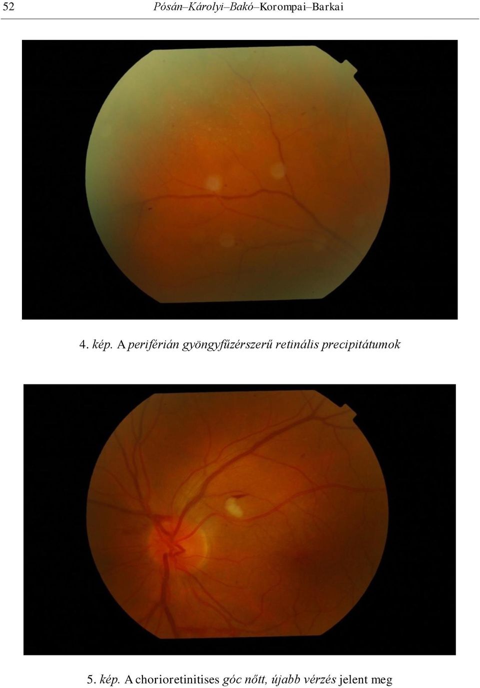 retinális precipitátumok 5. kép.