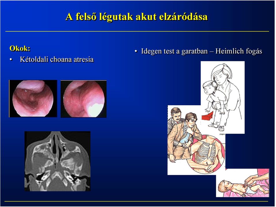 Kétoldali choana atresia