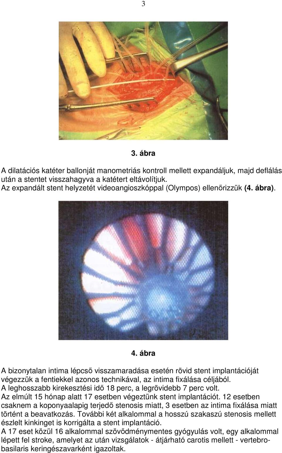 ábra A bizonytalan intima lépcsı visszamaradása esetén rövid stent implantációját végezzük a fentiekkel azonos technikával, az intima fixálása céljából.