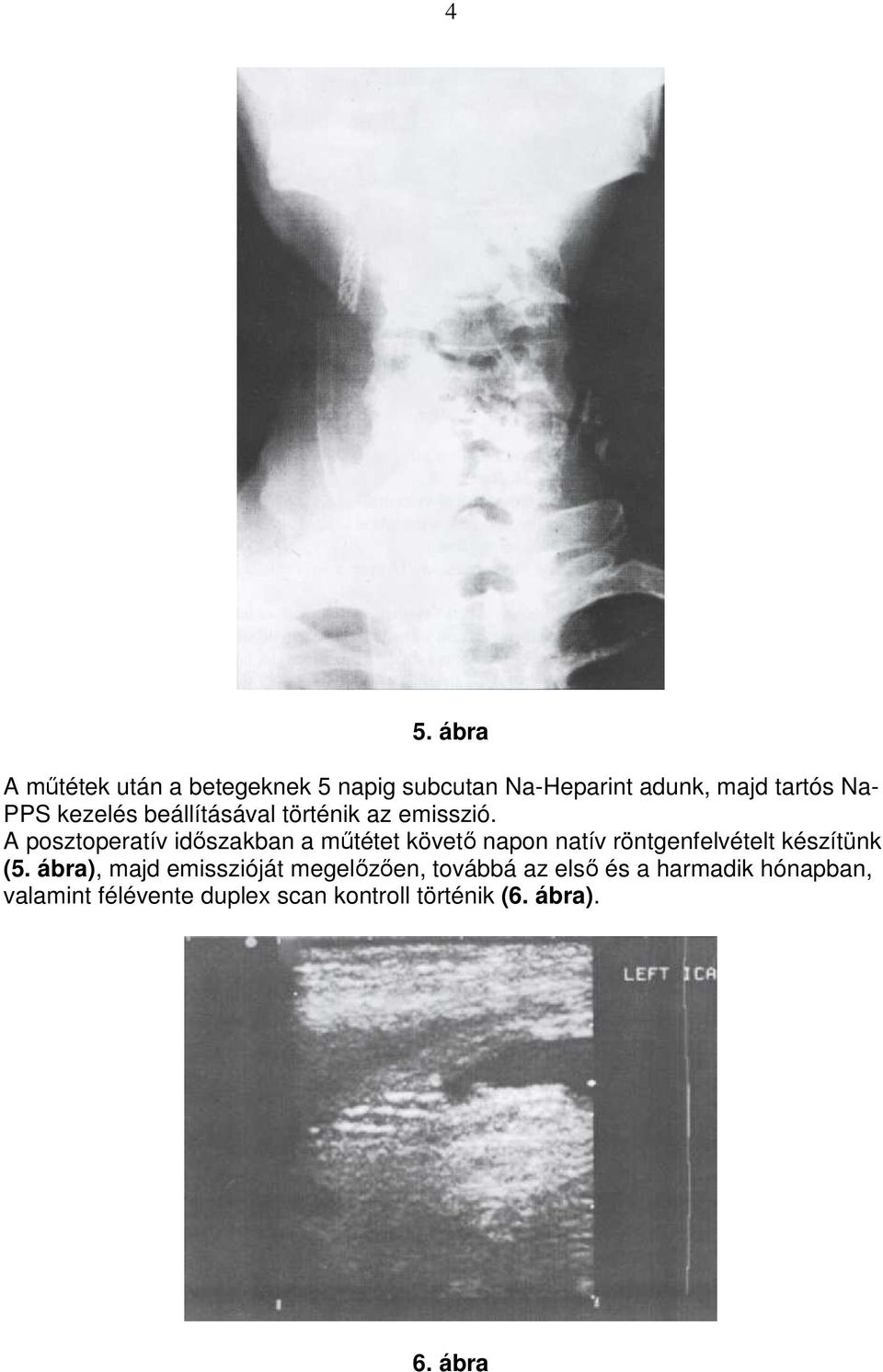 A posztoperatív idıszakban a mőtétet követı napon natív röntgenfelvételt készítünk (5.