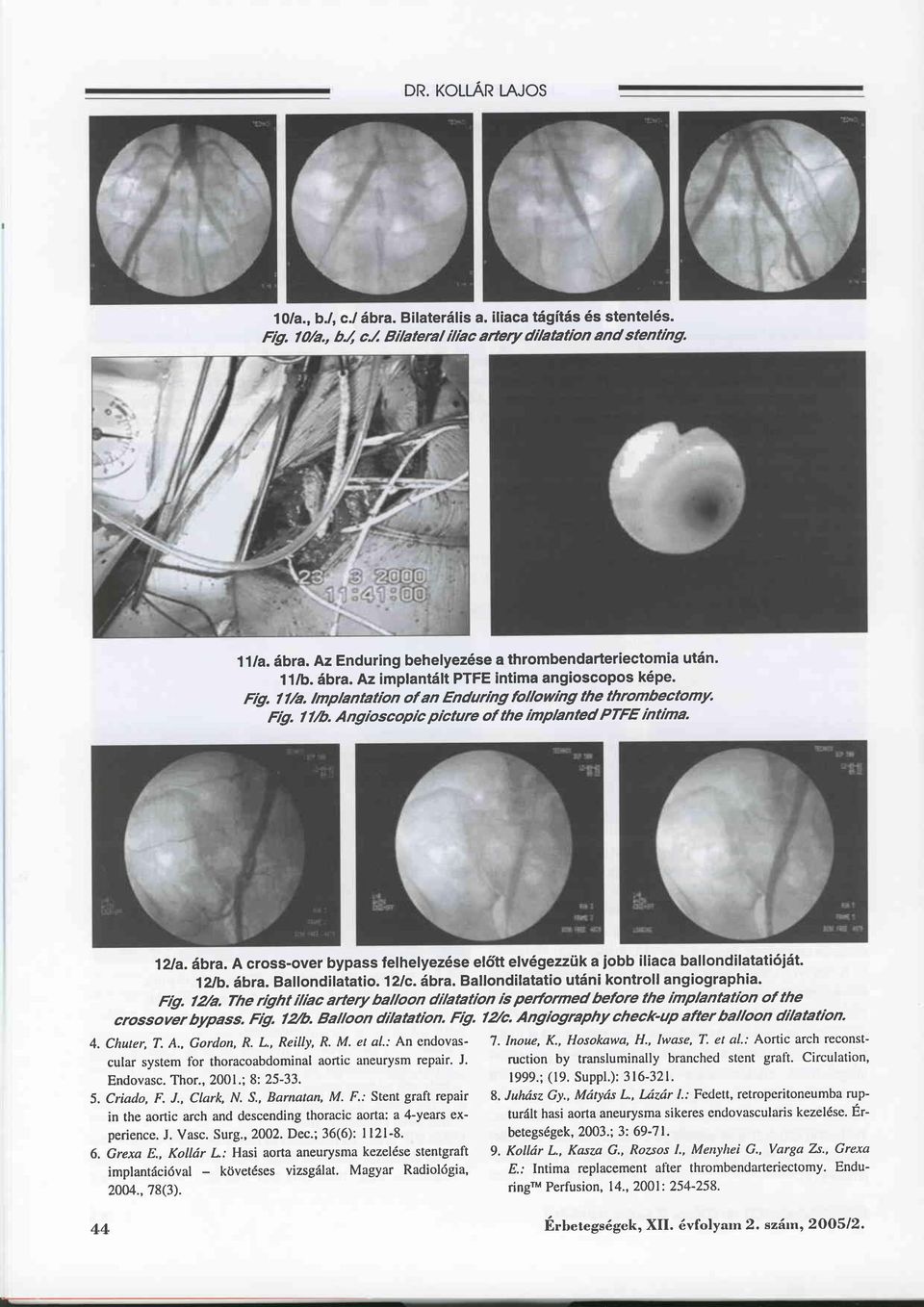 12tb. äbra. Ballondilatalio.l2lc. äbra. Ballonditatatio utäni kontroll angiographia. Frg. l2/a.