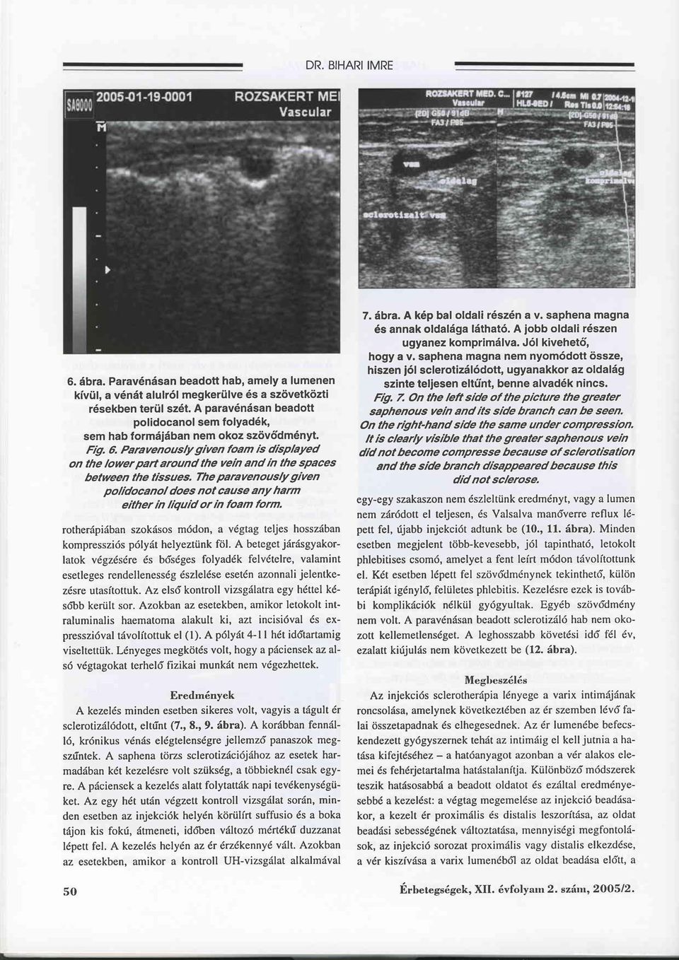 The paravenouslygiven polidocanol does not cause any harm either m liqutd or m foam form. rotheräpiäban szokäsos mödon, a vdgtag teljes hosszäban kompresszids pdlyät helyeztünk fö.