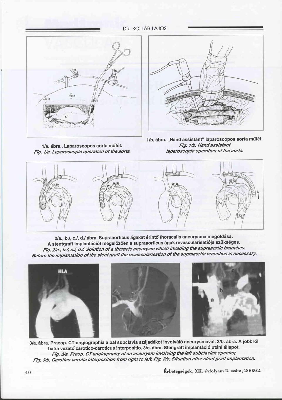 A stentgraft implantäci6t megelözöen a supraaorticus ägak revascularisati6ia szüks6ges. Fig.2/a., i.(, c.4 dj Solutrbn of a thoracic aneurysm which inuadrhg the supraaortrb branches.