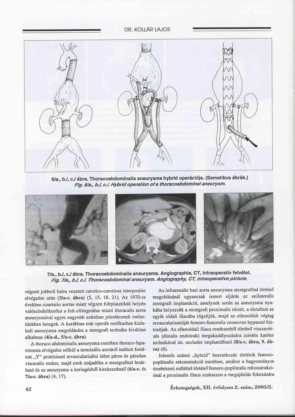 v gzettjobbröl balra vezetett carotico-caroticus interpositio elvdgz se utän (3/a-c.