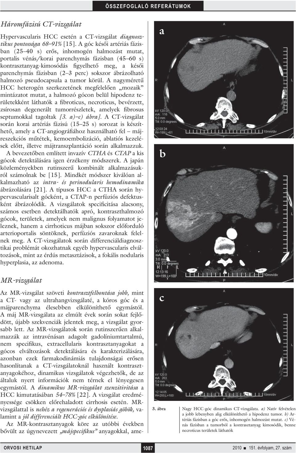 perc) sokszor ábrázolható halmozó pseudocapsula a tumor körül.