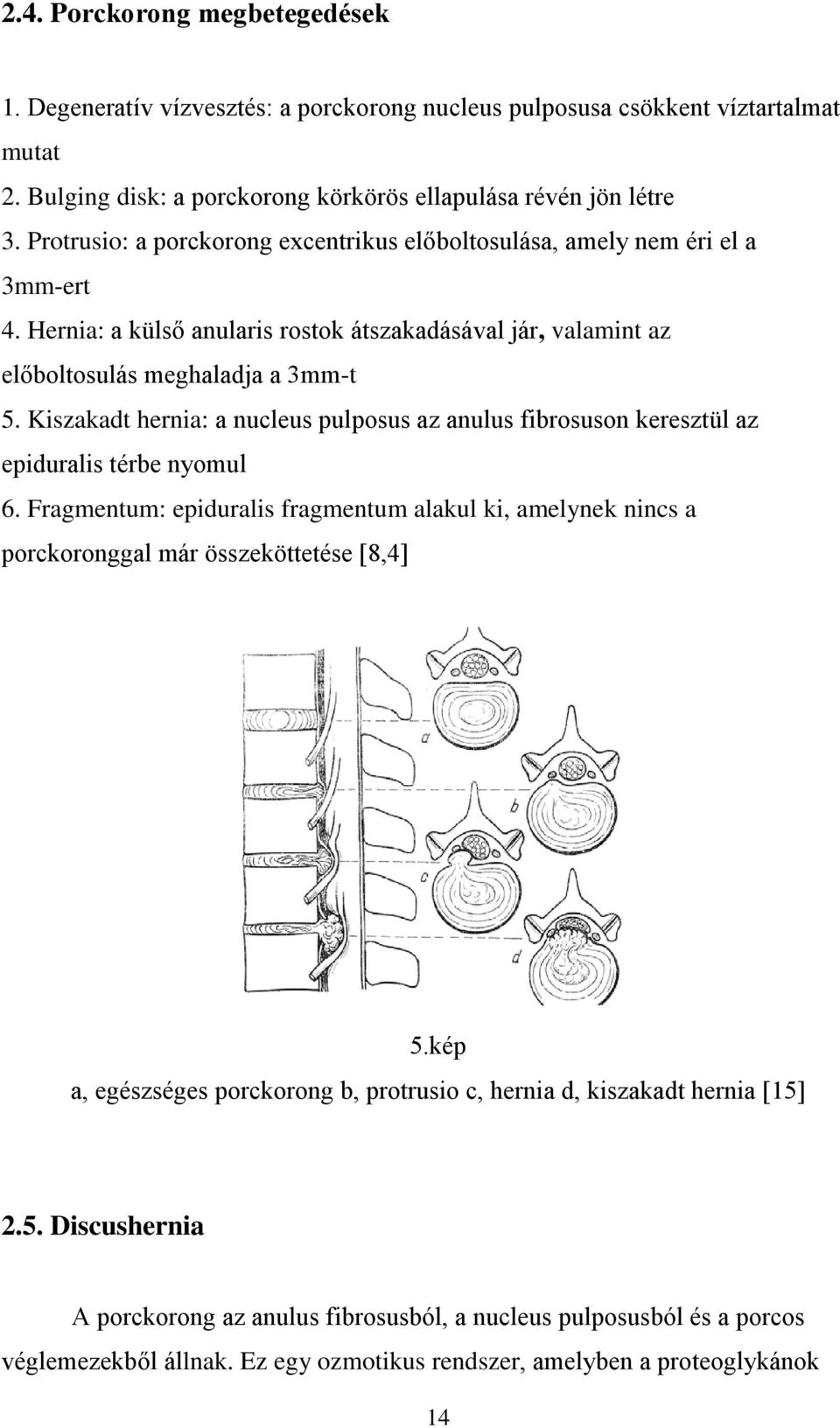 Kiszakadt hernia: a nucleus pulposus az anulus fibrosuson keresztül az epiduralis térbe nyomul 6.