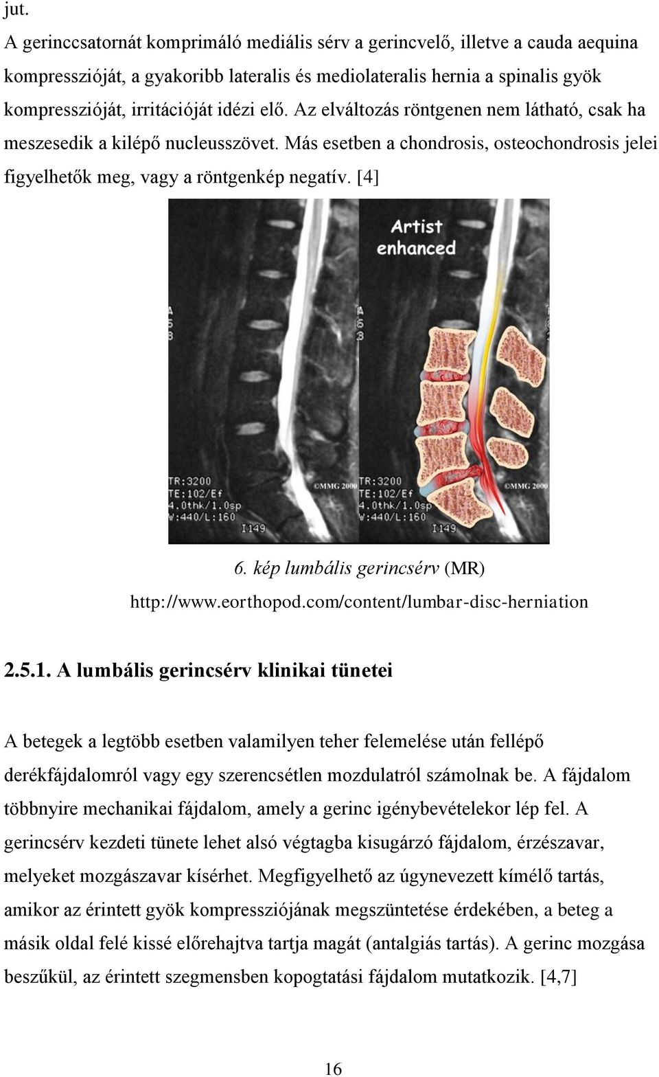 kép lumbális gerincsérv (MR) http://www.eorthopod.com/content/lumbar-disc-herniation 2.5.1.