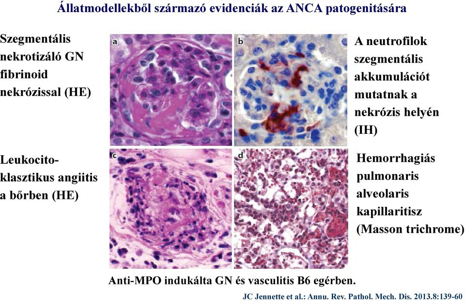 mutatnak a nekrózis helyén (IH) Hemorrhagiás pulmonaris alveolaris kapillaritisz (Masson trichrome)