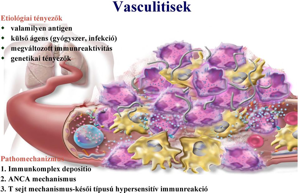 Vasculitisek Pathomechanizmus 1. Immunkomplex depositio 2.