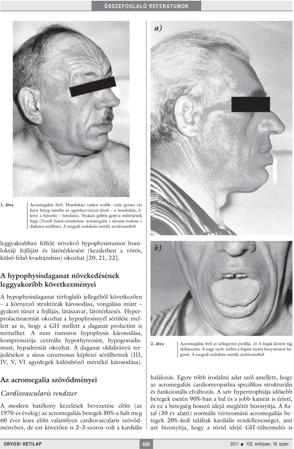 A szegedi endokrin osztály archívumából leggyakrabban felfelé növekvő hypophysistumor homloktáji fejfájást és látótérkiesést (kezdetben a vörös, külső-felső kvadránsban) okozhat [20, 21, 22].