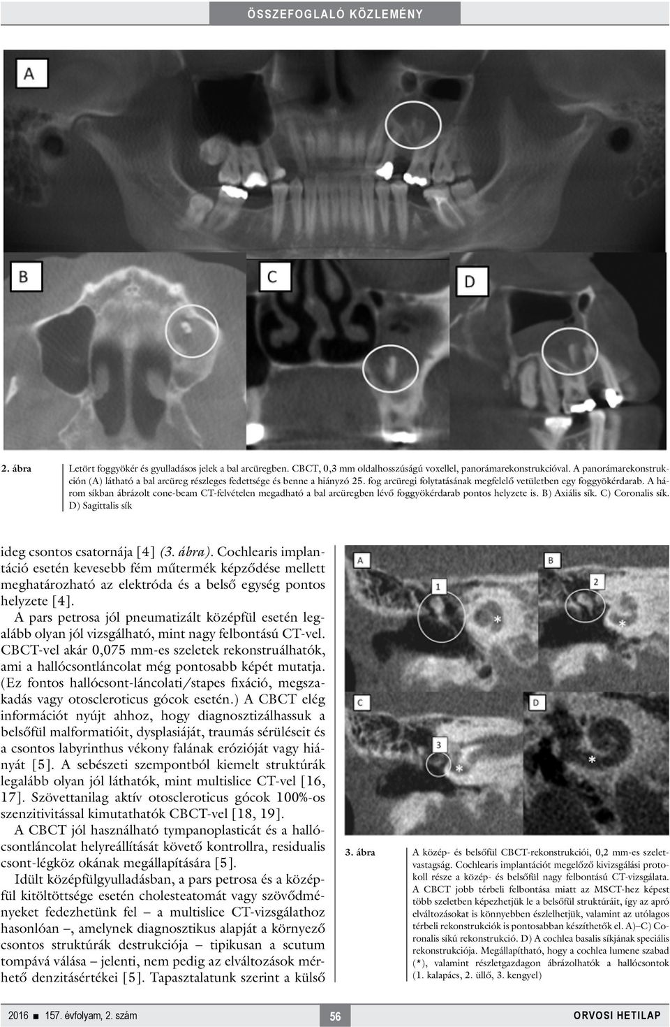 A három síkban ábrázolt cone-beam CT-felvételen megadható a bal arcüregben lévő foggyökérdarab pontos helyzete is. B) Axiális sík. C) Coronalis sík. D) Sagittalis sík ideg csontos csatornája [4] (3.