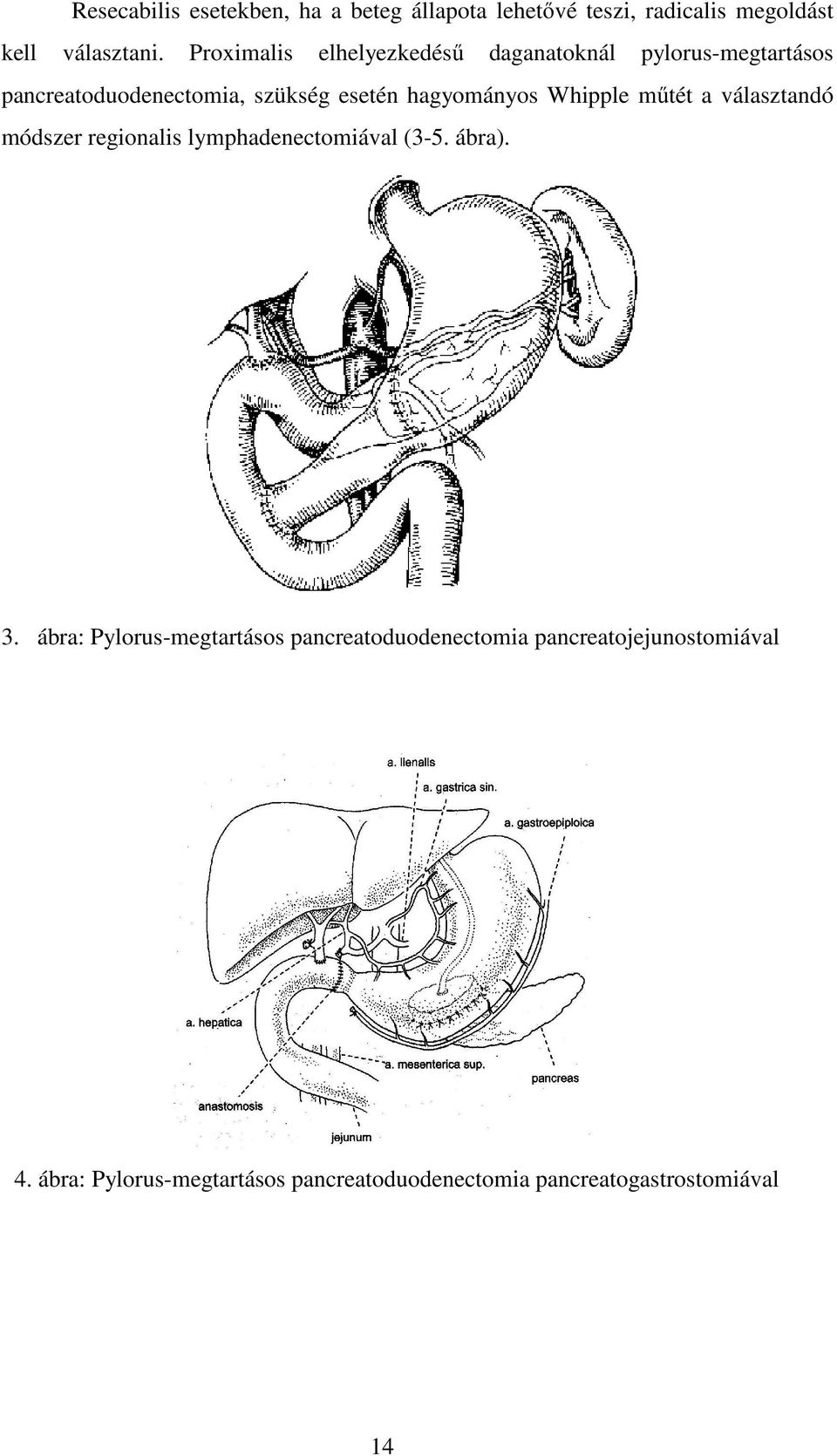 Whipple műtét a választandó módszer regionalis lymphadenectomiával (3-5. ábra). 3.