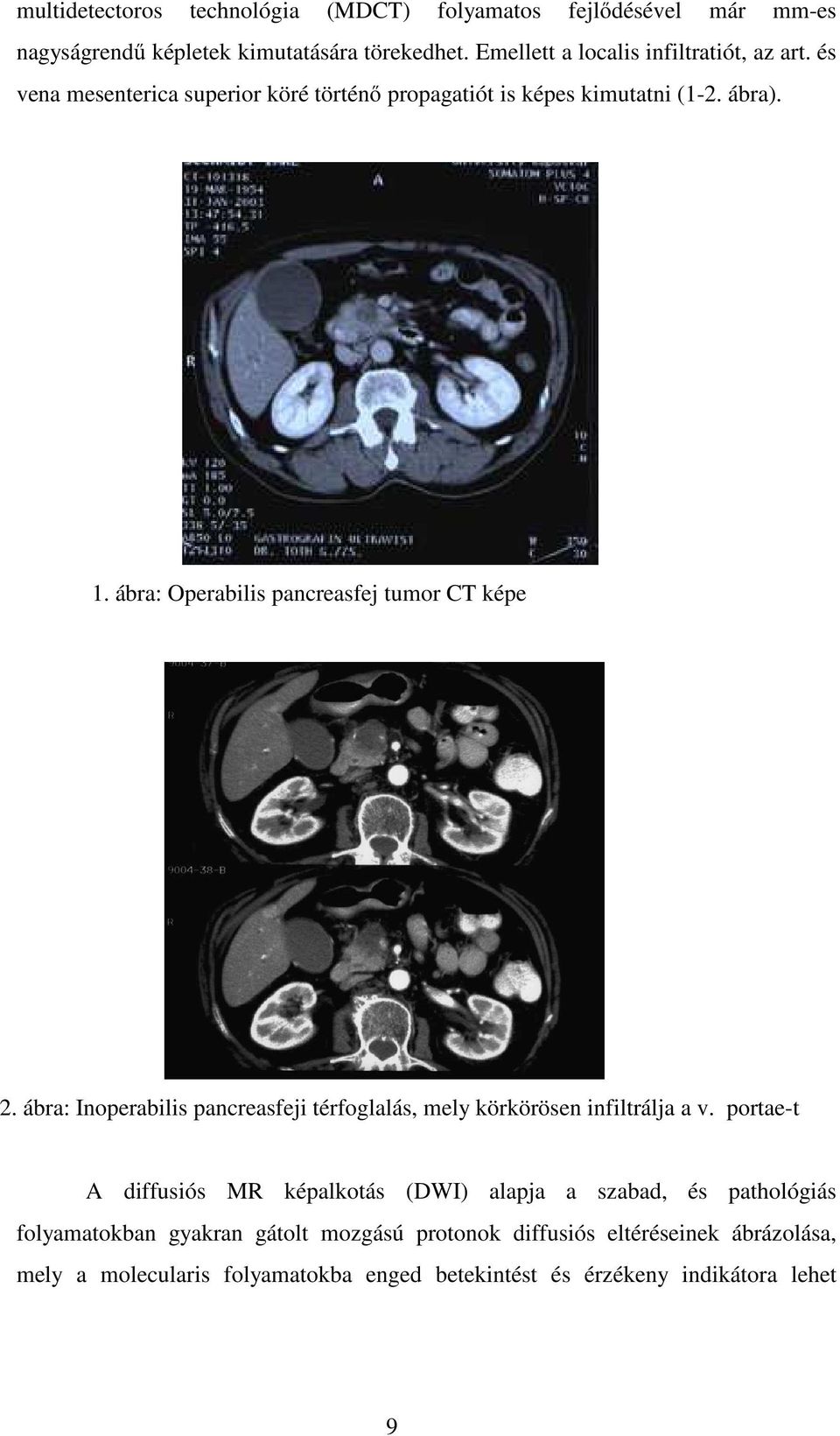 ábra: Operabilis pancreasfej tumor CT képe 2. ábra: Inoperabilis pancreasfeji térfoglalás, mely körkörösen infiltrálja a v.