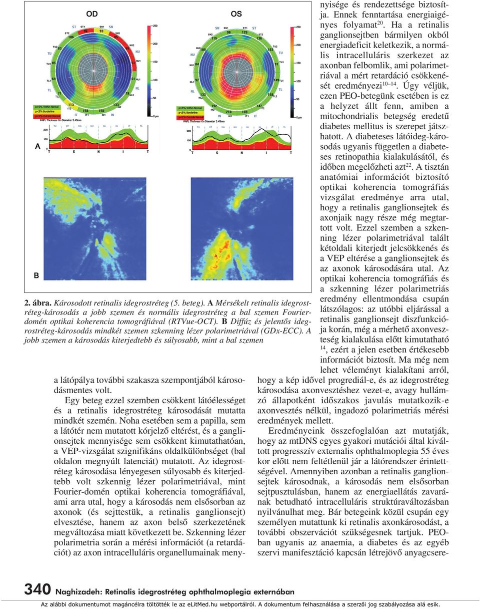B Diffúz és jelentôs idegrostréteg-károsodás mindkét szemen szkenning lézer polarimetriával (GDx-ECC).