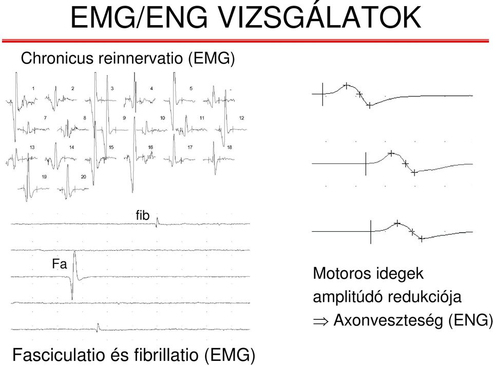 idegek amplitúdó redukciója