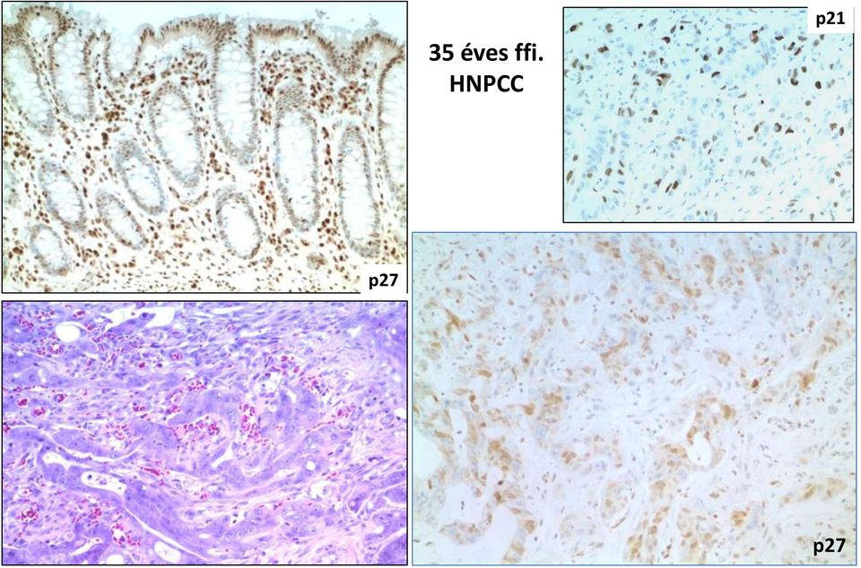 HNPCC p21