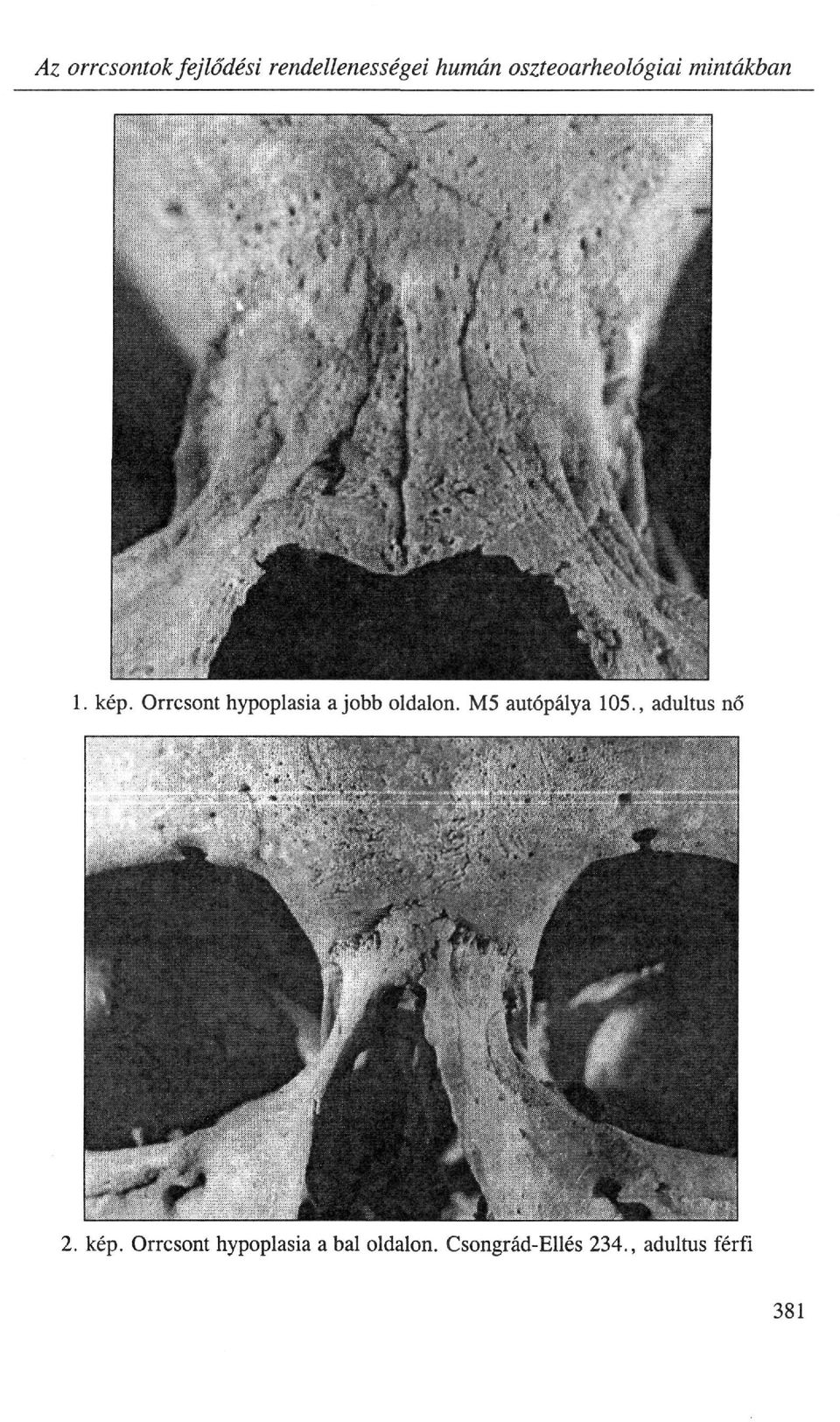 Orrcsont hypoplasia a jobb oldalon. M5 autópálya 105.