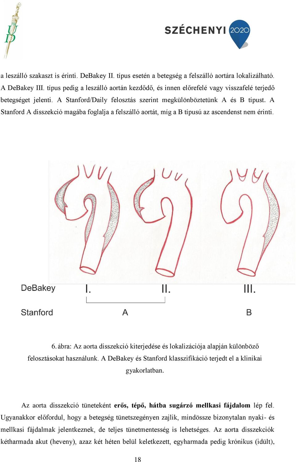 A Stanford A disszekció magába foglalja a felszálló aortát, míg a B típusú az ascendenst nem érinti. 6.