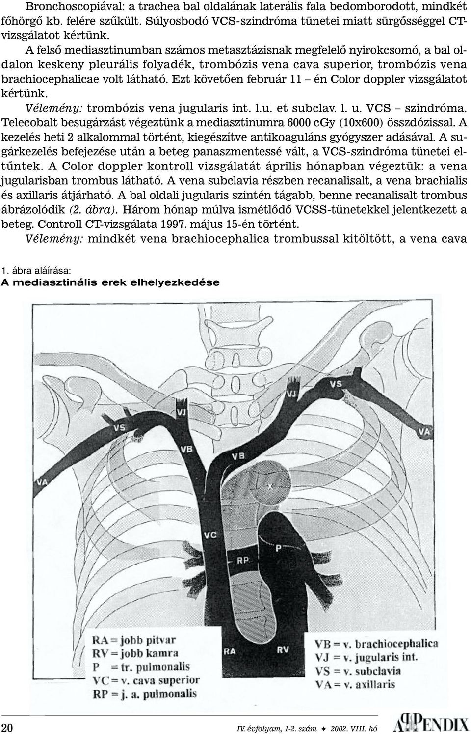 Ezt követõen február 11 én Color doppler vizsgálatot kértünk. Vélemény: trombózis vena jugularis int. l.u. et subclav. l. u. VCS szindróma.