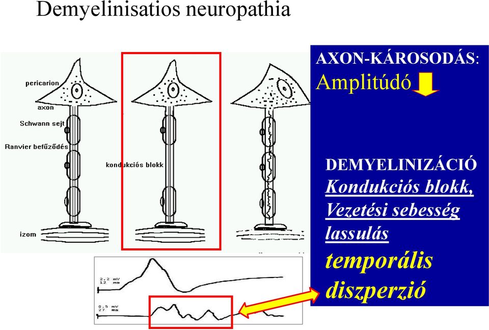 DEMYELINIZÁCIÓ Kondukciós blokk,