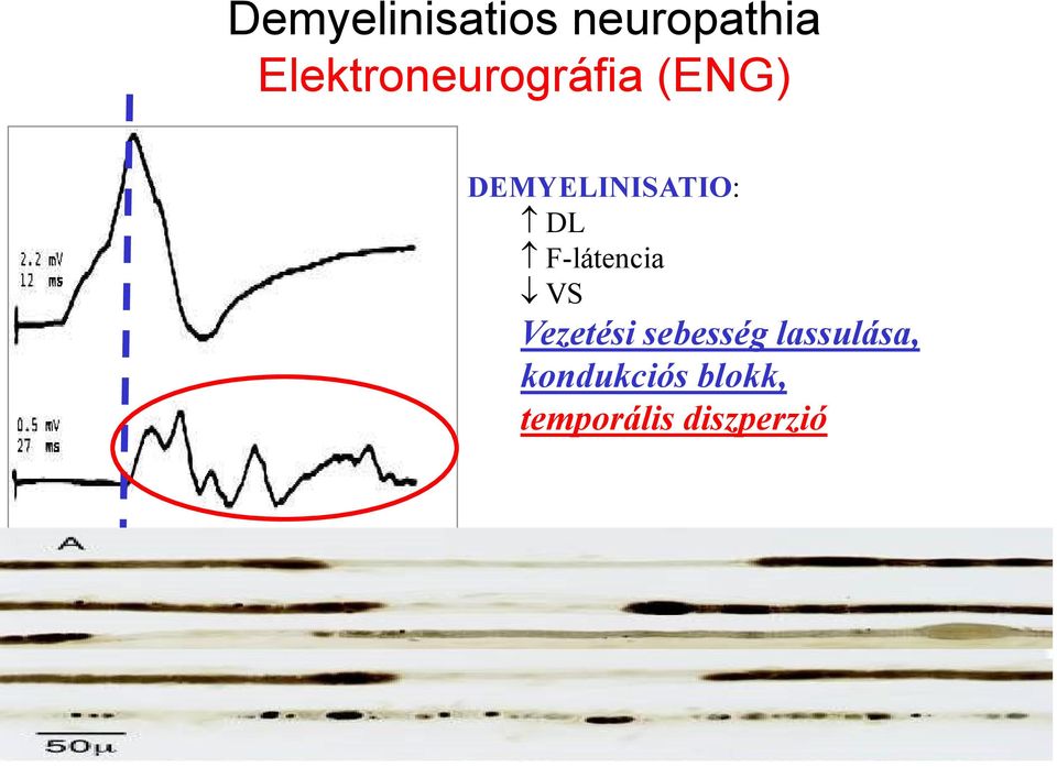 DEMYELINISATIO: DL F-látencia VS