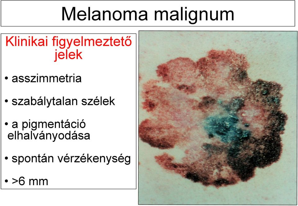 szabálytalan szélek a pigmentáció