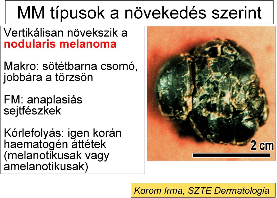 FM: anaplasiás sejtfészkek Kórlefolyás: igen korán haematogén