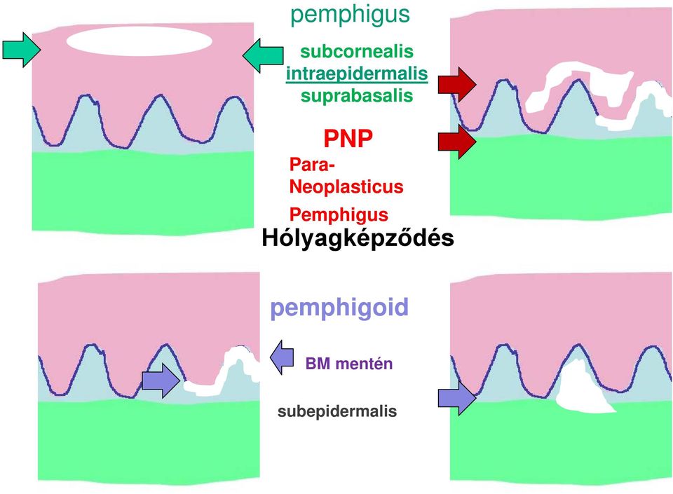 Para- Neoplasticus Pemphigus