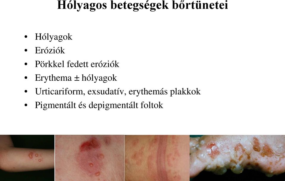 hólyagok Urticariform, exsudatív,