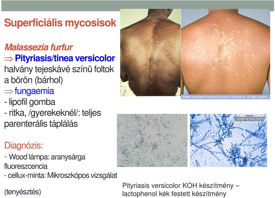 parenterális táplálás Diagnózis: - Wood lámpa: aranysárga fluoreszcencia - cellux-minta: