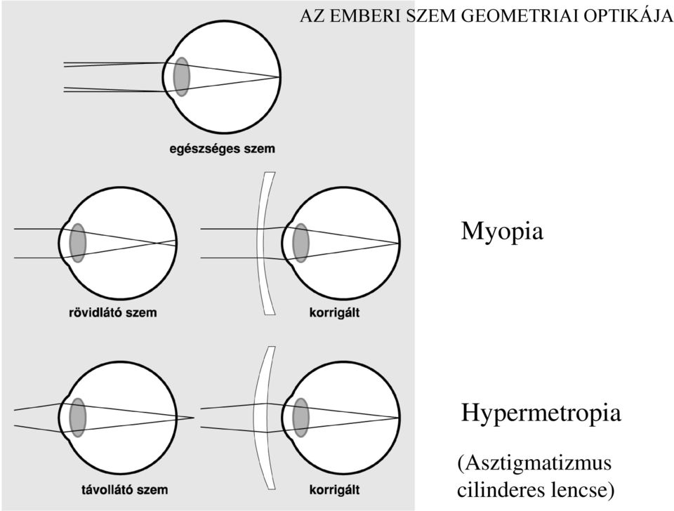 Myopia Hypermetropia