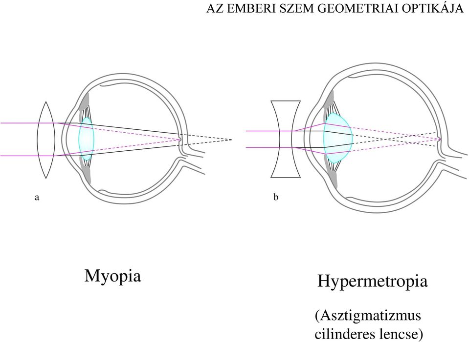 Myopia Hypermetropia