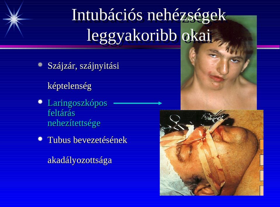 szájnyitási képtelenség Laringoszkópos