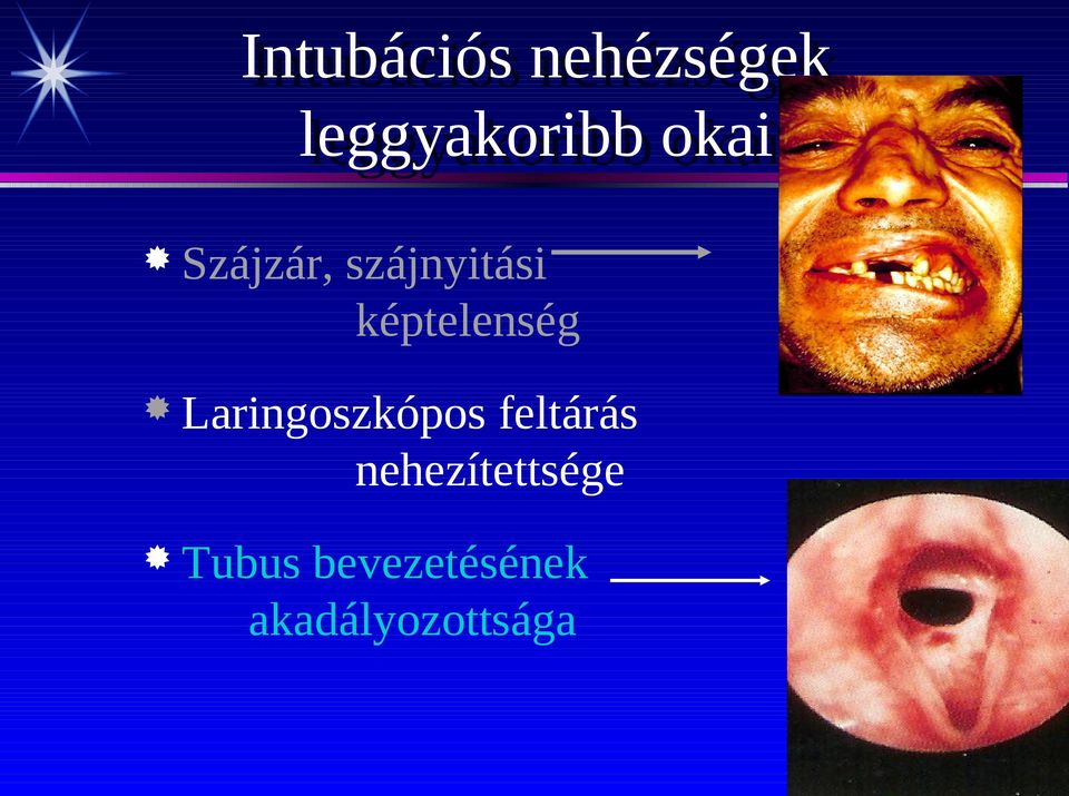 szájnyitási képtelenség Laringoszkópos