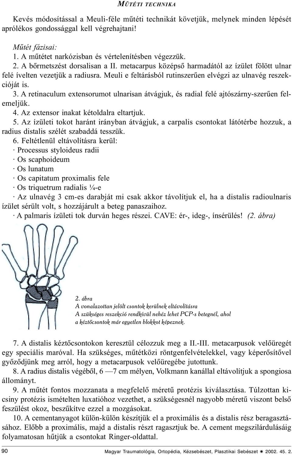 Meuli e feltárásból rutinszerûen elvégzi az ulnavég reszekcióját is. 3. A retinaculum extensorumot ulnarisan átvágjuk, és radial felé ajtószárny-szerûen felemeljük. 4.