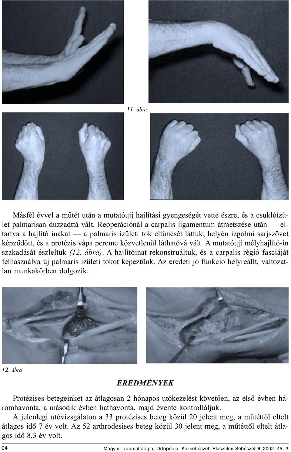 láthatóvá vált. A mutatóujj mélyhajlító-ín szakadását észleltük (12. ábra). A hajlítóinat rekonstruáltuk, és a carpalis régió fasciáját felhasználva új palmaris ízületi tokot képeztünk.