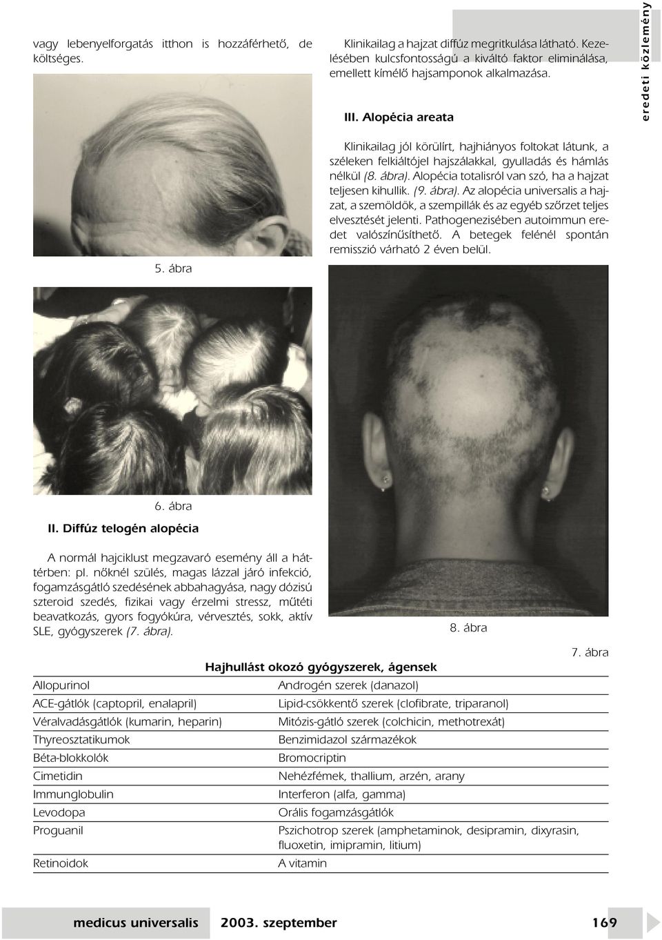 ábra Klinikailag jól körülírt, hajhiányos foltokat látunk, a széleken felkiáltójel hajszálakkal, gyulladás és hámlás nélkül (8. ábra). Alopécia totalisról van szó, ha a hajzat teljesen kihullik. (9.