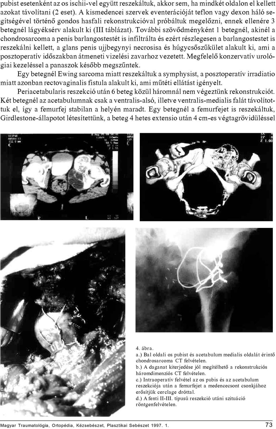 További szövõdményként 1 betegnél, akinél a chondrosarcoma a penis barlangostestét is infiltrálta és ezért részlegesen a barlangostestet is reszekálni kellett, a glans penis ujjbegynyi necrosisa és
