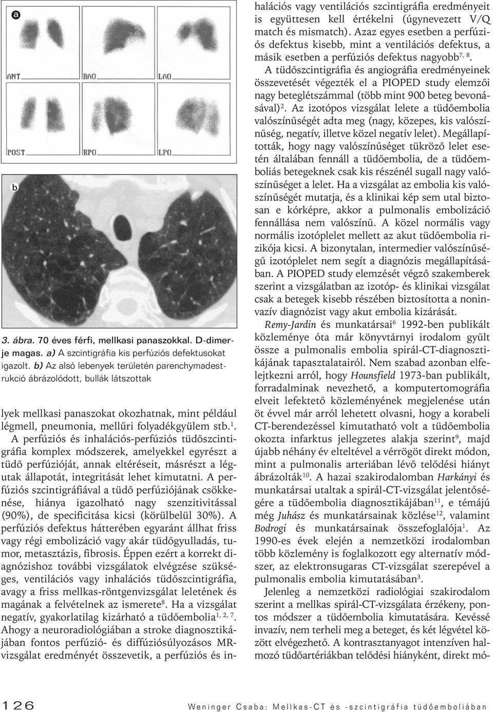 A perfúziós és inhalációs-perfúziós tüdôszcintigráfia komplex módszerek, amelyekkel egyrészt a tüdô perfúzióját, annak eltéréseit, másrészt a légutak állapotát, integritását lehet kimutatni.