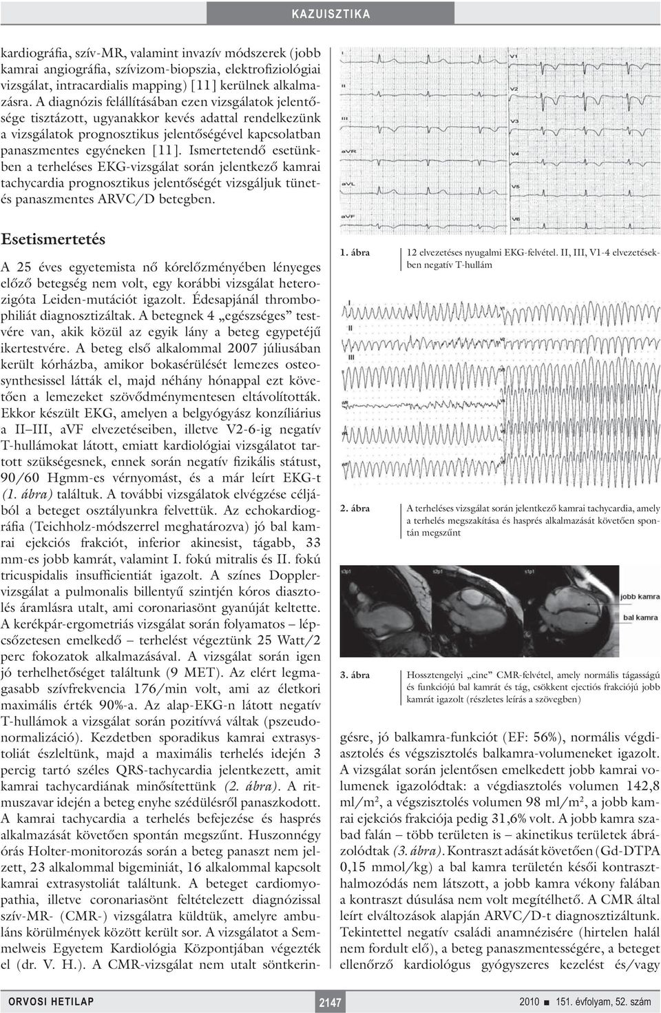 Ismertetendő esetünkben a terheléses EKG-vizsgálat során jelentkező kamrai tachycardia prognosztikus jelentőségét vizsgáljuk tünetés panaszmentes ARVC/D betegben.