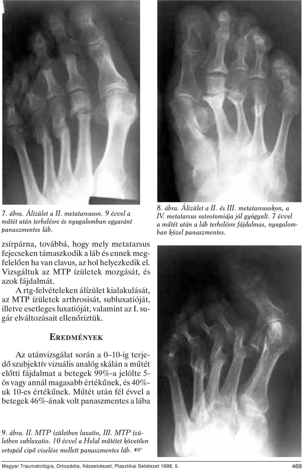 A rtg-felvételeken álízület kialakulását, az MTP ízületek arthrosisát, subluxatióját, illetve esetleges luxatióját, valamint az I. sugár elváltozásait ellenôriztük. 8. ábra. Álízület a II. és III.